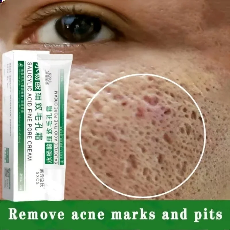 Azelaic Acid Cream - Крем для очищения пор с салициловой