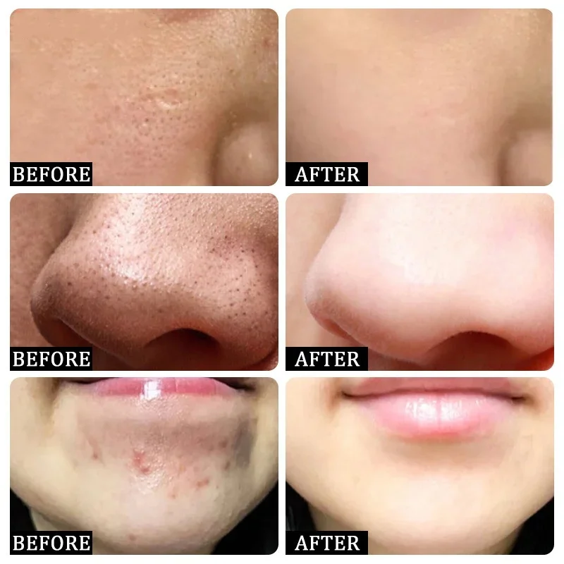 Крем для очищения пор с салици – обзор и цена Azelaic Acid Cream