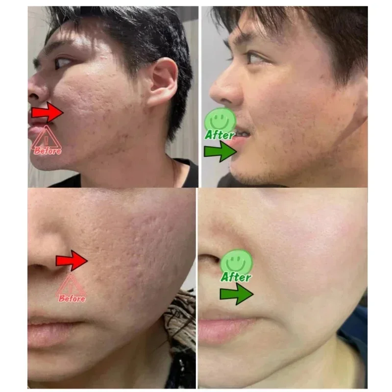 Крем для очищения пор с салици – обзор и цена Azelaic Acid Cream
