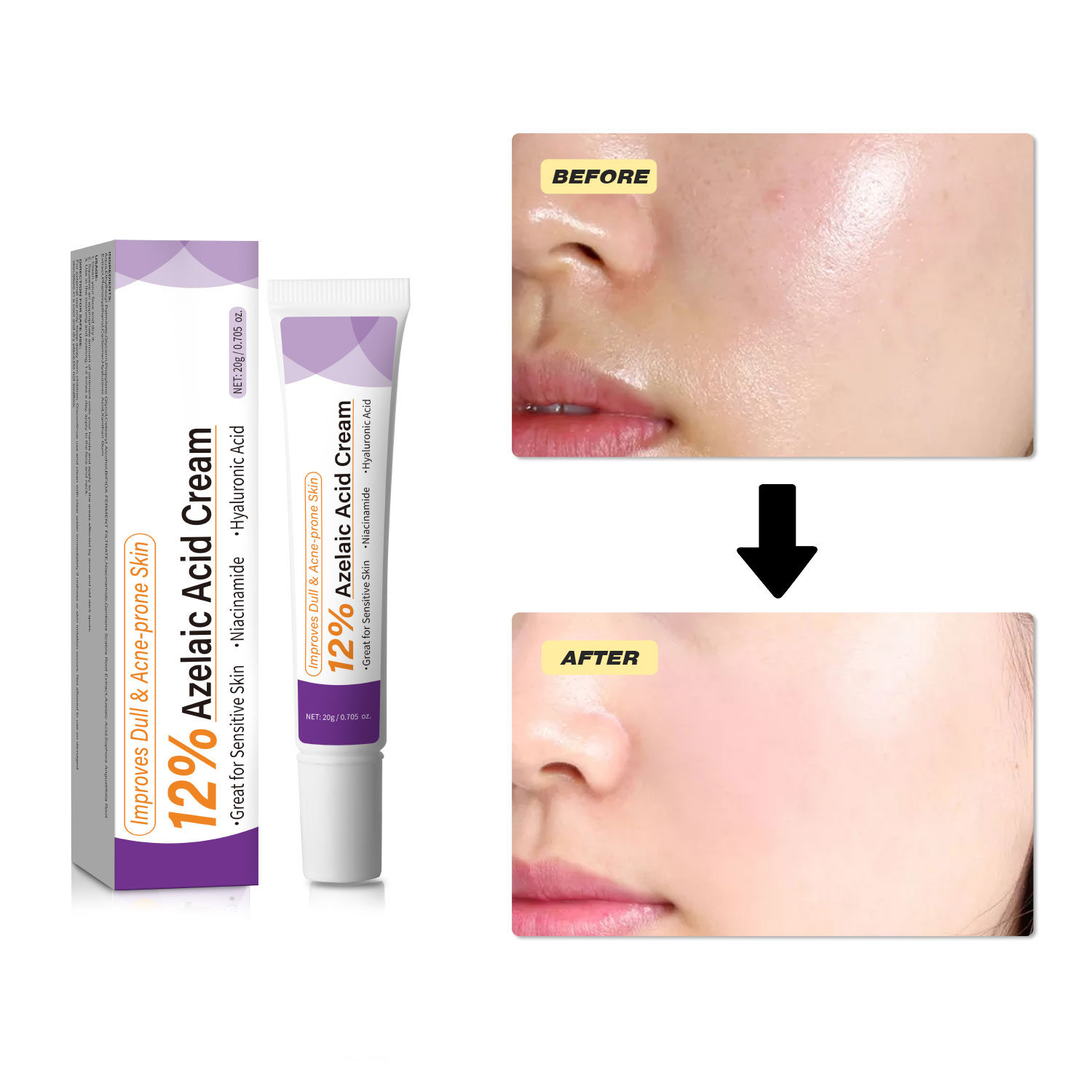 Мягкий крем с азелаиновой кисл – обзор и цена Azelaic Acid Cream